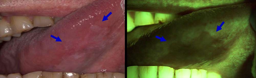 Oral-Cancer-Tongue