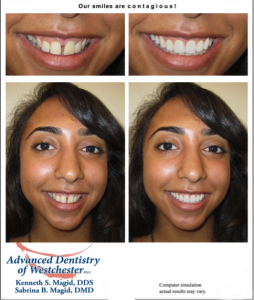 Smile Makeover Cosmetic Dentistry Westchester County 