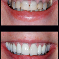 A before and after picture of teeth with and without braces.