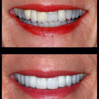 A woman 's smile before and after teeth whitening.