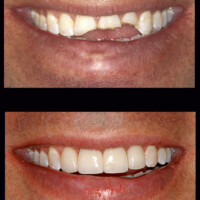 A before and after picture of the teeth that were chipped.