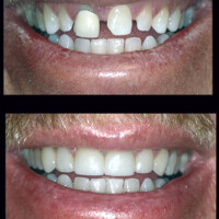 Split smile showing dental restoration results