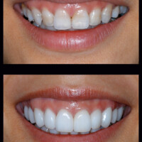 Gummy smile corrected with porcelain veneers