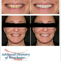 A woman 's smile is shown in three different stages of her teeth.
