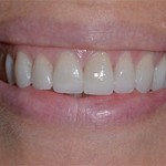 Cosmetic Dentistry Veneers Dr. Magid 