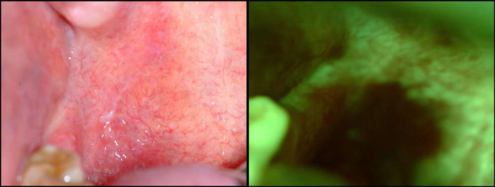 oral-cancer-palate-Velscope