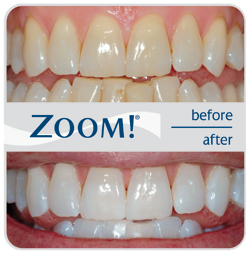 Teeth Whitening Westchester NY Zoom!®